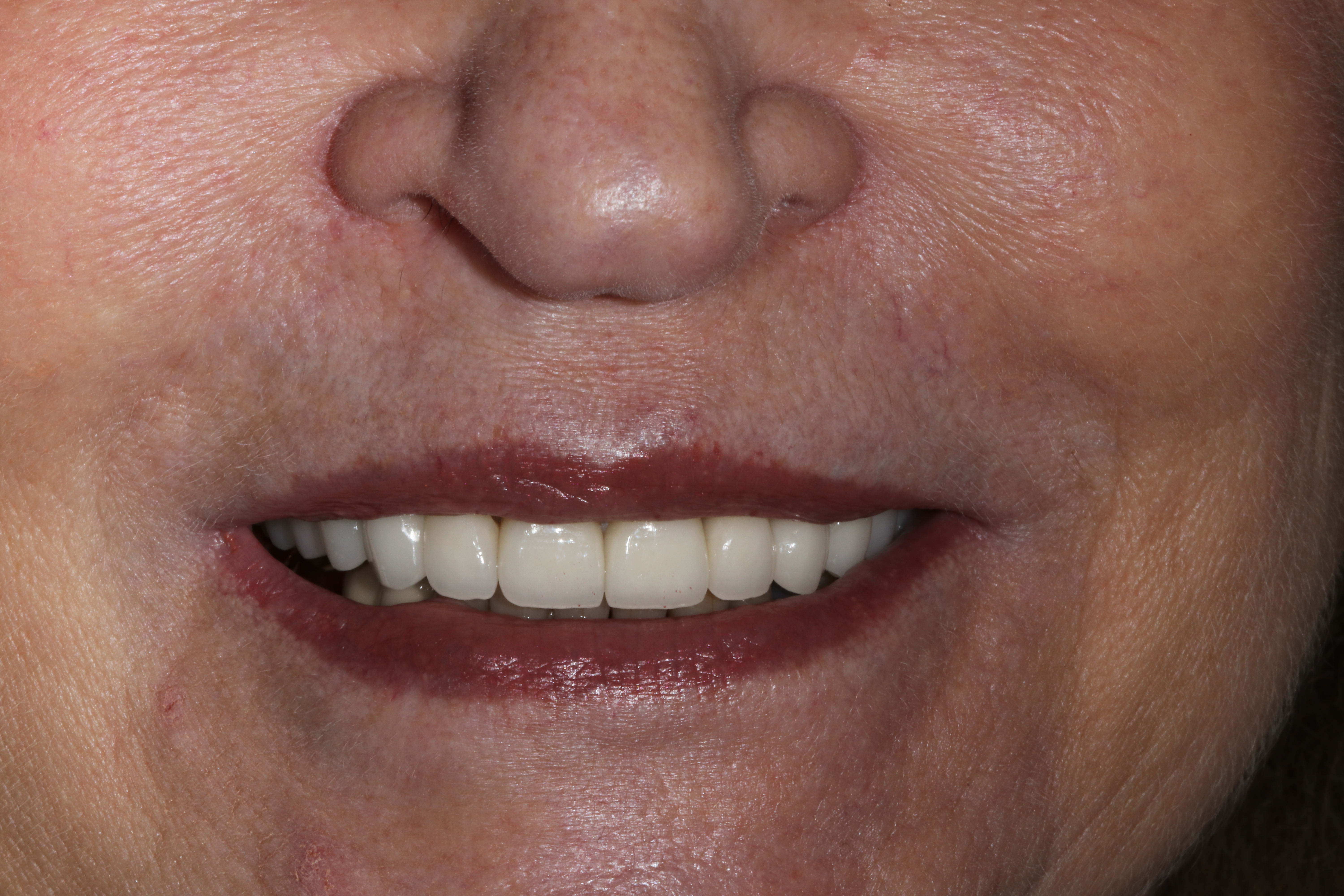 After Anti-Aging Dentistry From Russo DDS